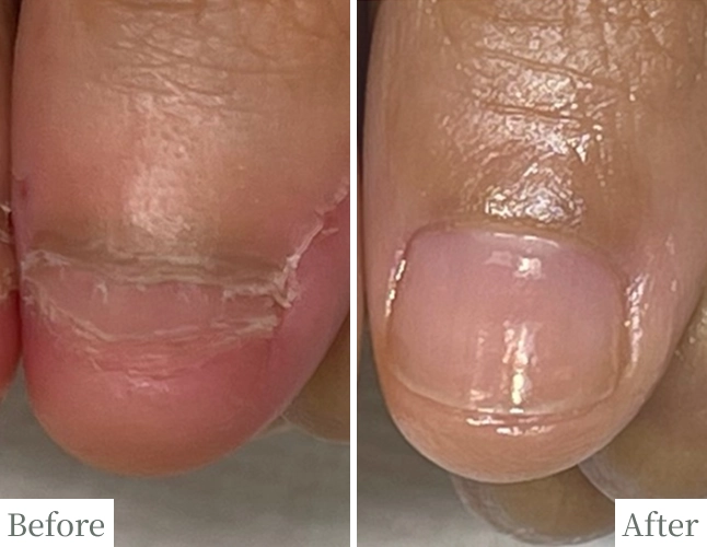 噛み爪のBefore/After比較