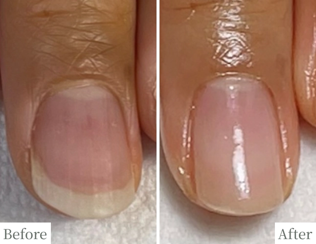 噛み爪のBefore/After比較