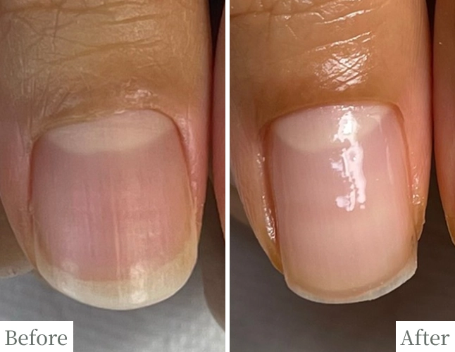 噛み爪のBefore/After比較